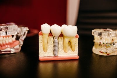 Dental Implants in Tulsa